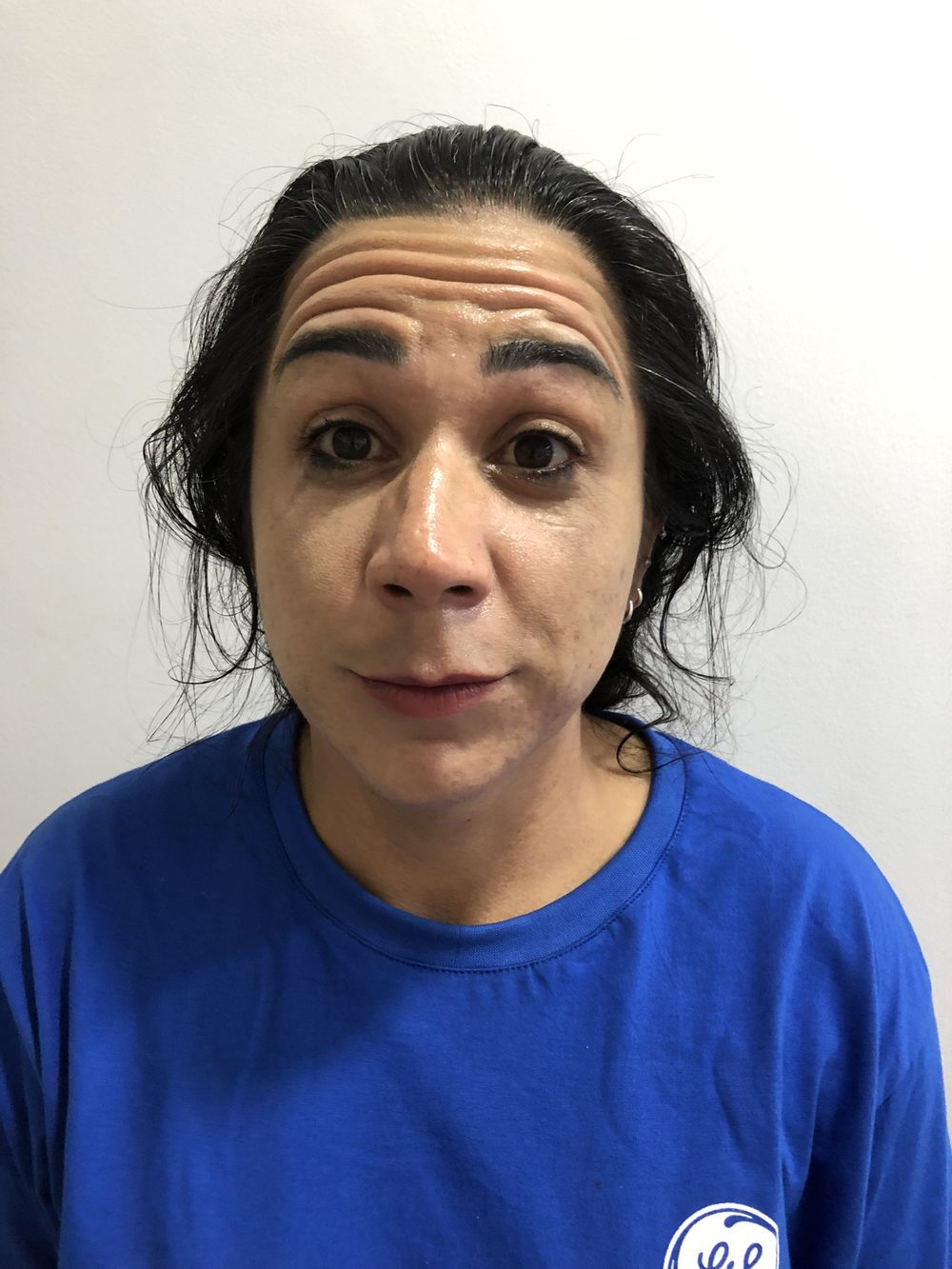 Antes - Toxina Botulínica