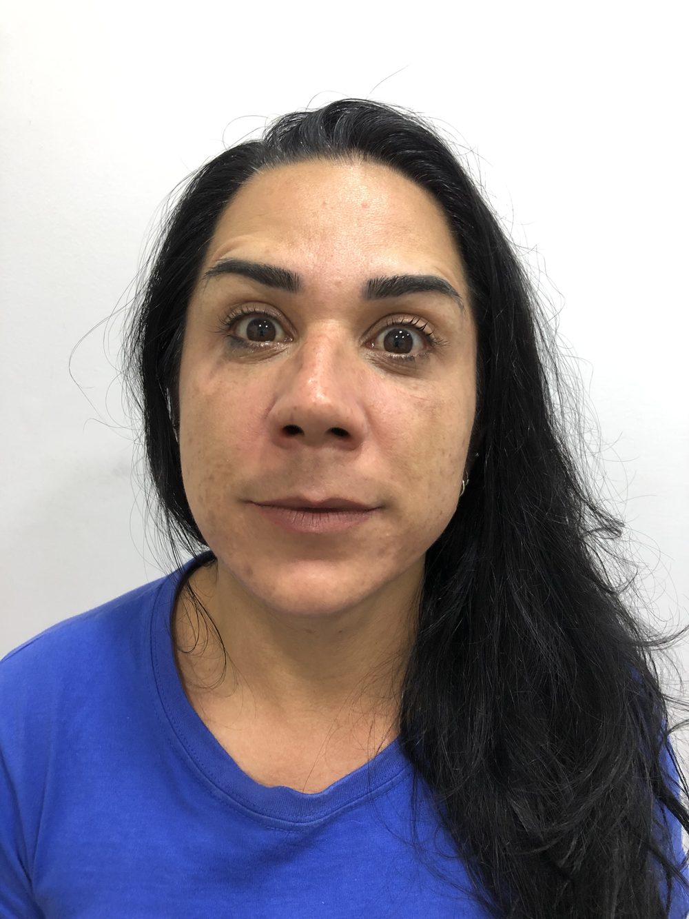 Depois - Toxina Botulínica