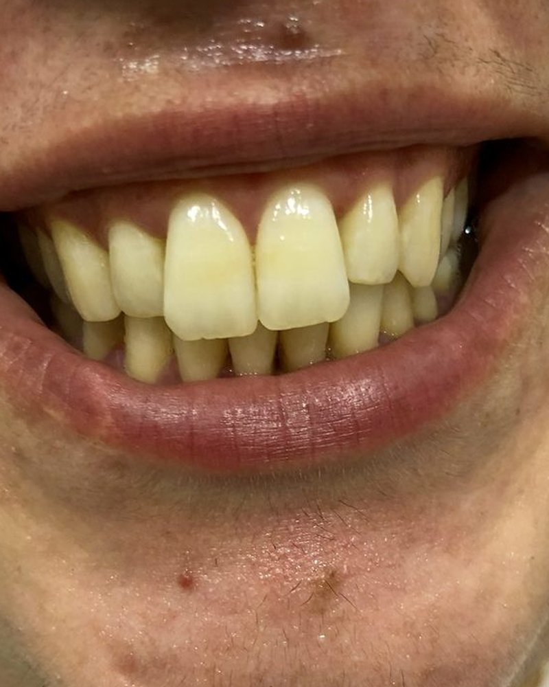 Antes - Clareamento